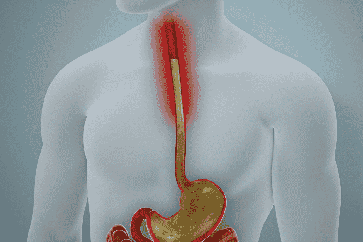 Esophagus Surgery