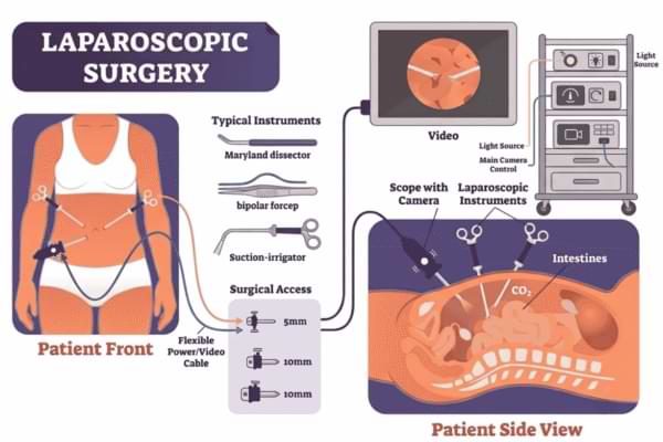Laparoscopic Surgery in Ahmedabad