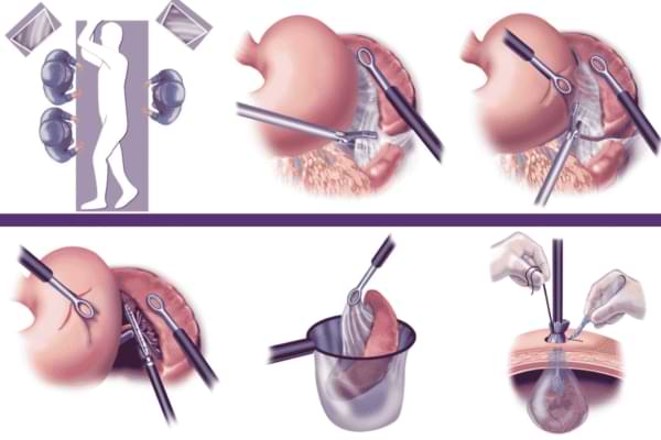 spleen surgery in ahmedabad